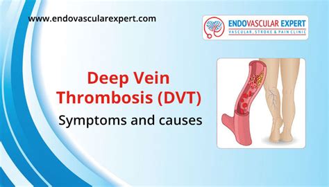 Deep Vein Thrombosis | Symptoms and Causes | EndovascularExpert