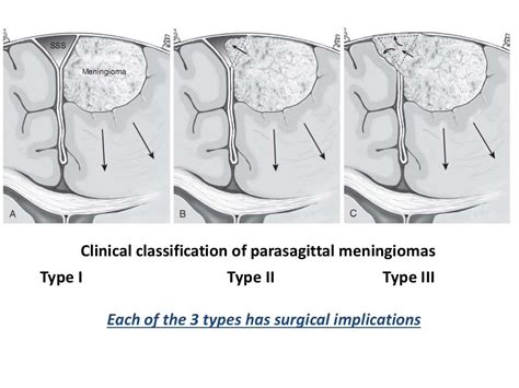 Parasagittal meningioma