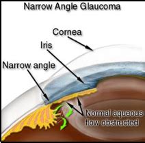 Coastal Eye Care: Technology: LPI – Coastal Eye Care