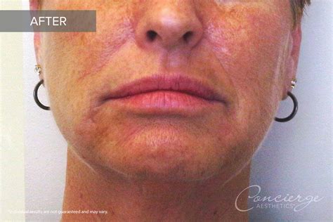 Before and After - Juvederm Ultra and Voluma (55 yo) | Concierge Aesthetics