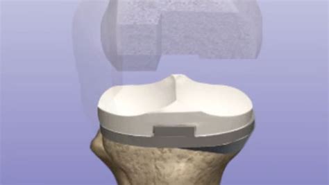 Revision Knee Replacement – UnderstandOrtho™