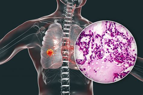 Savolitinib May Be Effective in Treating Pulmonary Sarcomatoid ...