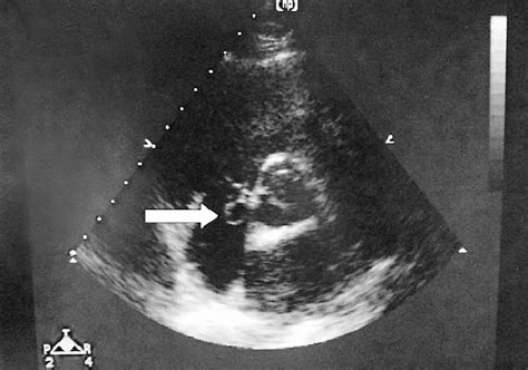 Transthoracic echocardiography discloses an aneurysm of the sinus of ...