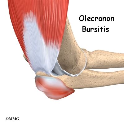 Olecranon Bursitis | eOrthopod.com