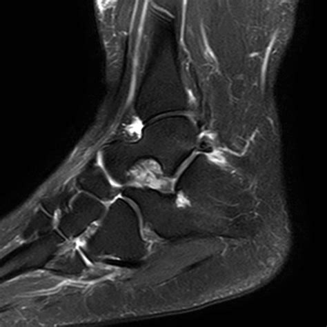 Sinus Tarsi Mri