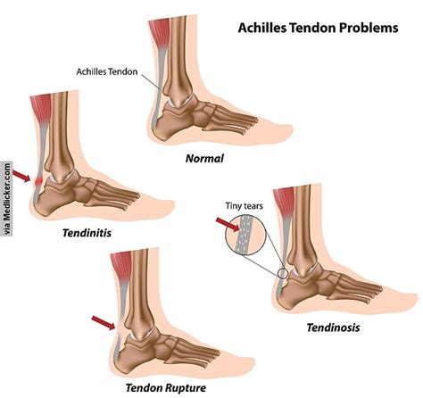 Achilles tendon injury: causes, symptoms, diagnosis, treatment and ...