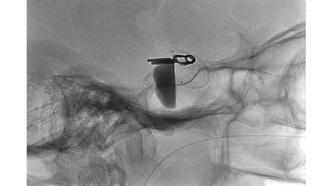 Oman boy undergoes bullet shrapnel removal surgery at Aster Medcity - Healthcare Radius