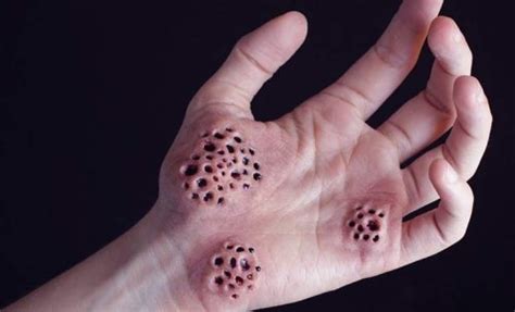 Trypophobia: Symptoms, Causes, and Treatments - Exploring your mind