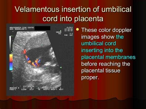 Placenta ultrasound