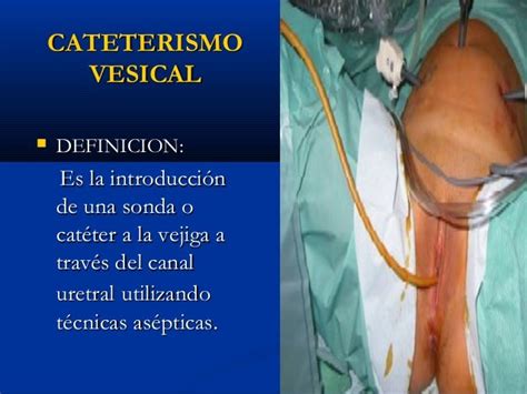 Cateterismo vesical