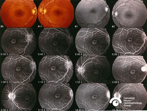 » 0018. Bull’s eye maculopathyCanadian Neuro-ophthalmology Group