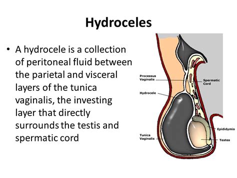 Hydrocele Symptoms, Causes And Treatment - Herbal Care Products