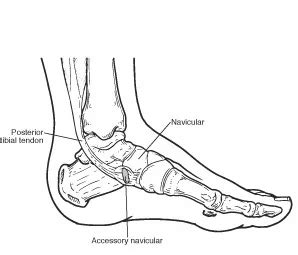 Accessory Navicular Syndrome: Causes, Symptoms and Treatment