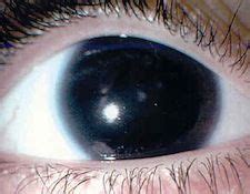 No iris, only a huge pupil. Black eye color doesn't exist. This is the eye of a person with ...