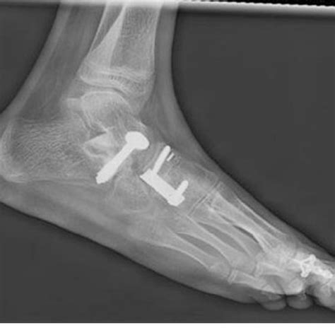 Subtalar fusion procedure with cuneonavicular joint fusion and proximal... | Download Scientific ...