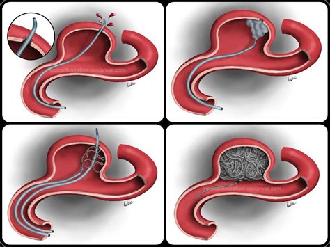 Ladvic - Medical illustration - Aneurysm Coiling Complications