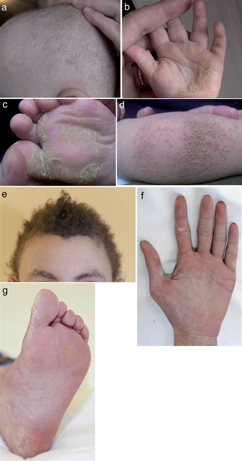 Desmoplakin Mutations with Palmoplantar Keratoderma, Woolly Hair and Cardiomyopathy | HTML ...