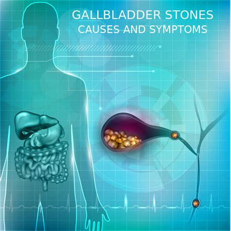 Gallbaldder Stones: Causes and Symptoms - Medfin