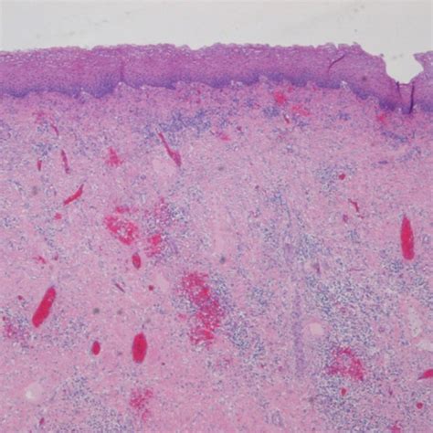 Histological features of giant inflammatory polyp demonstrating mixture... | Download Scientific ...