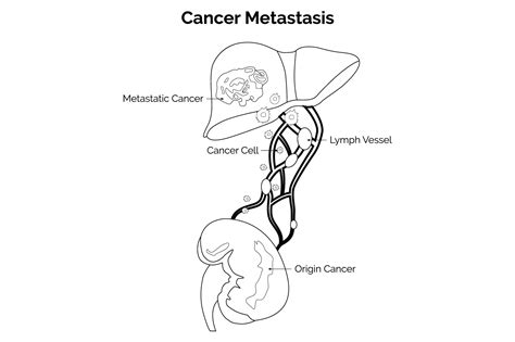 Cancer Metastasis Science Design Vector Graphic by hamjaiu · Creative ...