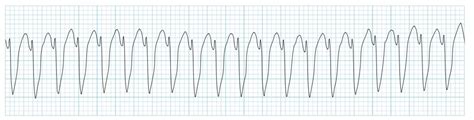 Ventricular Arrhythmias - USMLE Strike