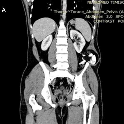 -Coronal and axial pelvic CT scan at two years postoperative showing no... | Download Scientific ...