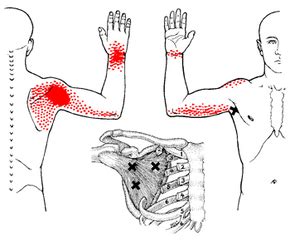 Shoulder Pain Brachial Plexus Impingement - SANDEE WINN