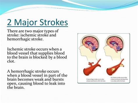 PPT - Cerebrovascular Accident (Stroke) PowerPoint Presentation - ID ...