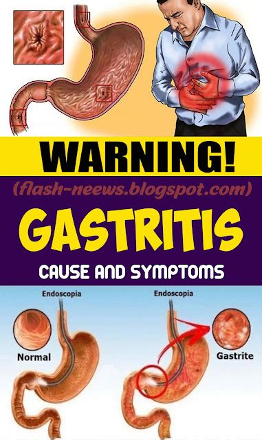 Gastritis – causes and side effects