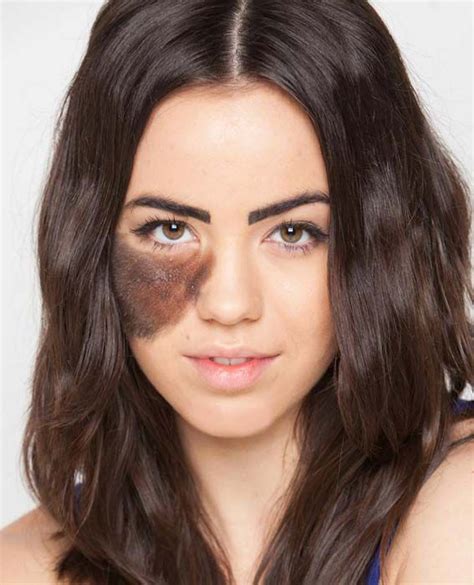 Celebrities Embracing Their Birthmarks