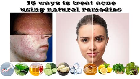 16 ways to treat acne using natural remedies - YouTube