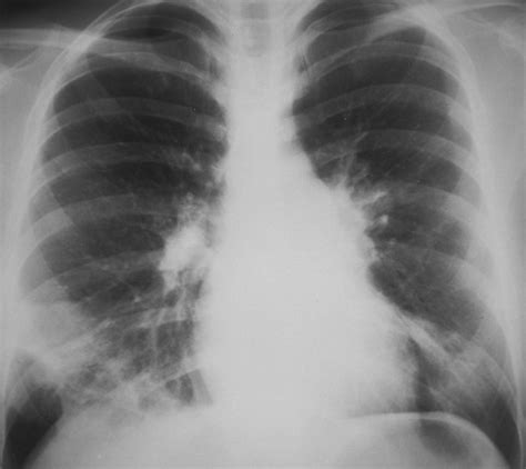 Mycoplasma pneumoniae Pneumonia Radiographic and High-Resolution CT ...