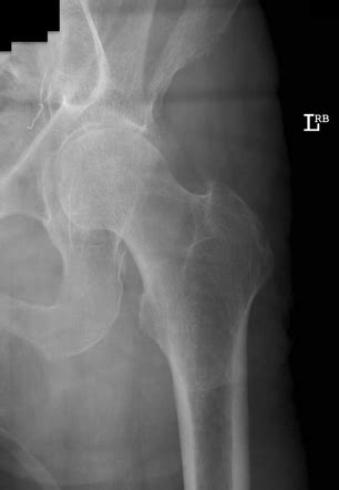 Iliac wing fracture | Image | Radiopaedia.org