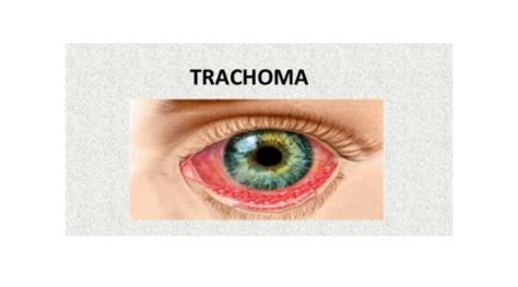 What is eye trachoma? How is it treated? | OBN