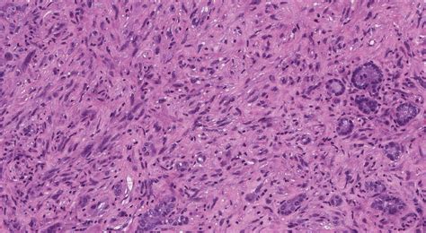 Anaplastic thyroid carcinoma | MyPathologyReport.ca