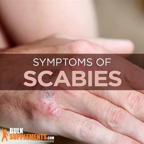 Scabies: Symptoms, Causes & Treatment