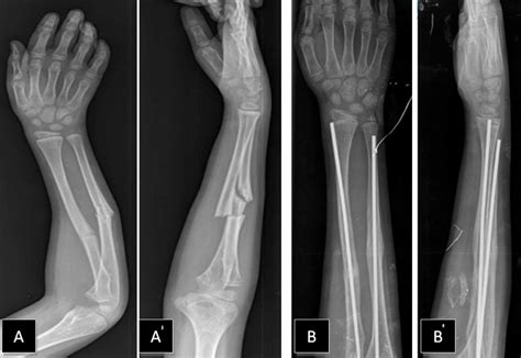 Cureus | Pediatric Forearm Refracture with Intramedullary Nail Bending In Situ: Options for ...