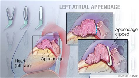 To have or not to have…your left atrial appendage closed - Mayo Clinic News Network