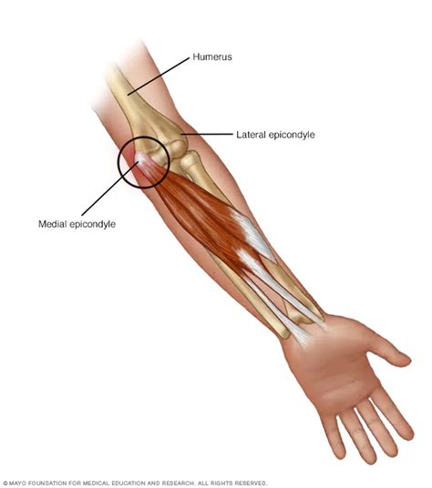 Dolor de codo: ¿por qué me duele y que puedo hacer?