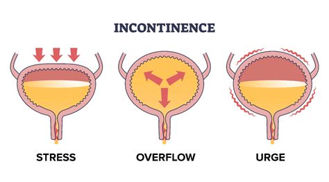 Incontinence - Integrative Urology