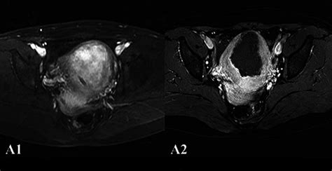 Enhanced MRI in a 40-year-old patient with adenomyosis (group A). A1,... | Download Scientific ...