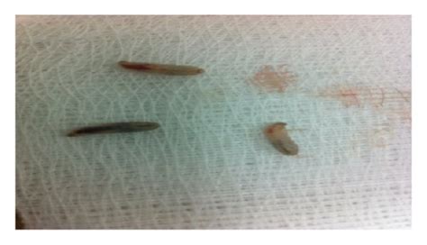 Three alive larvae removed from the patient ear. | Download Scientific ...