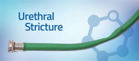 Urethral Stricture | Symptoms | Associated Urological Specialists