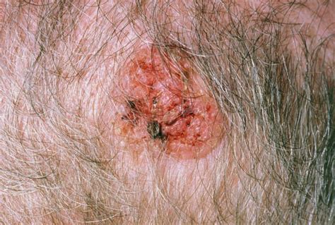 Squamous Cell Carcinoma