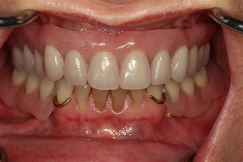 Implant Dentures (Partial)