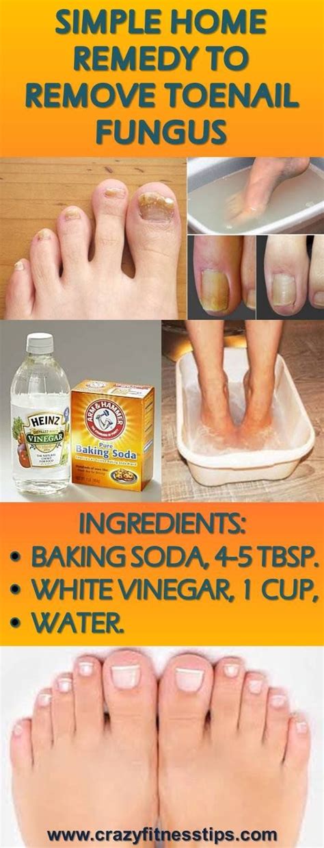 Simple Home Remedy to Remove Toenail Fungus - HEALTH RECIPES