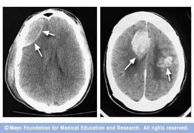 CT scan images of the brain - Mayo Clinic