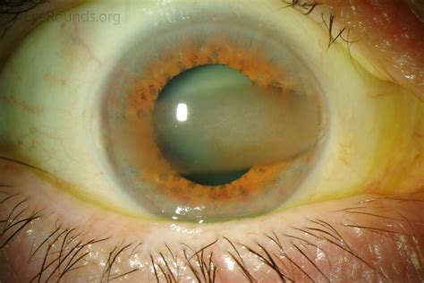 Calcific Band Keratopathy