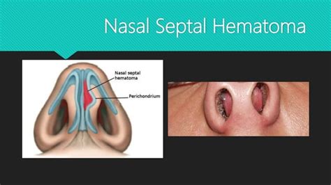 Nasal Septal Hematoma Drainage | PPT