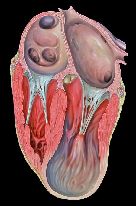 Left ventricular aneurysm - WikEM